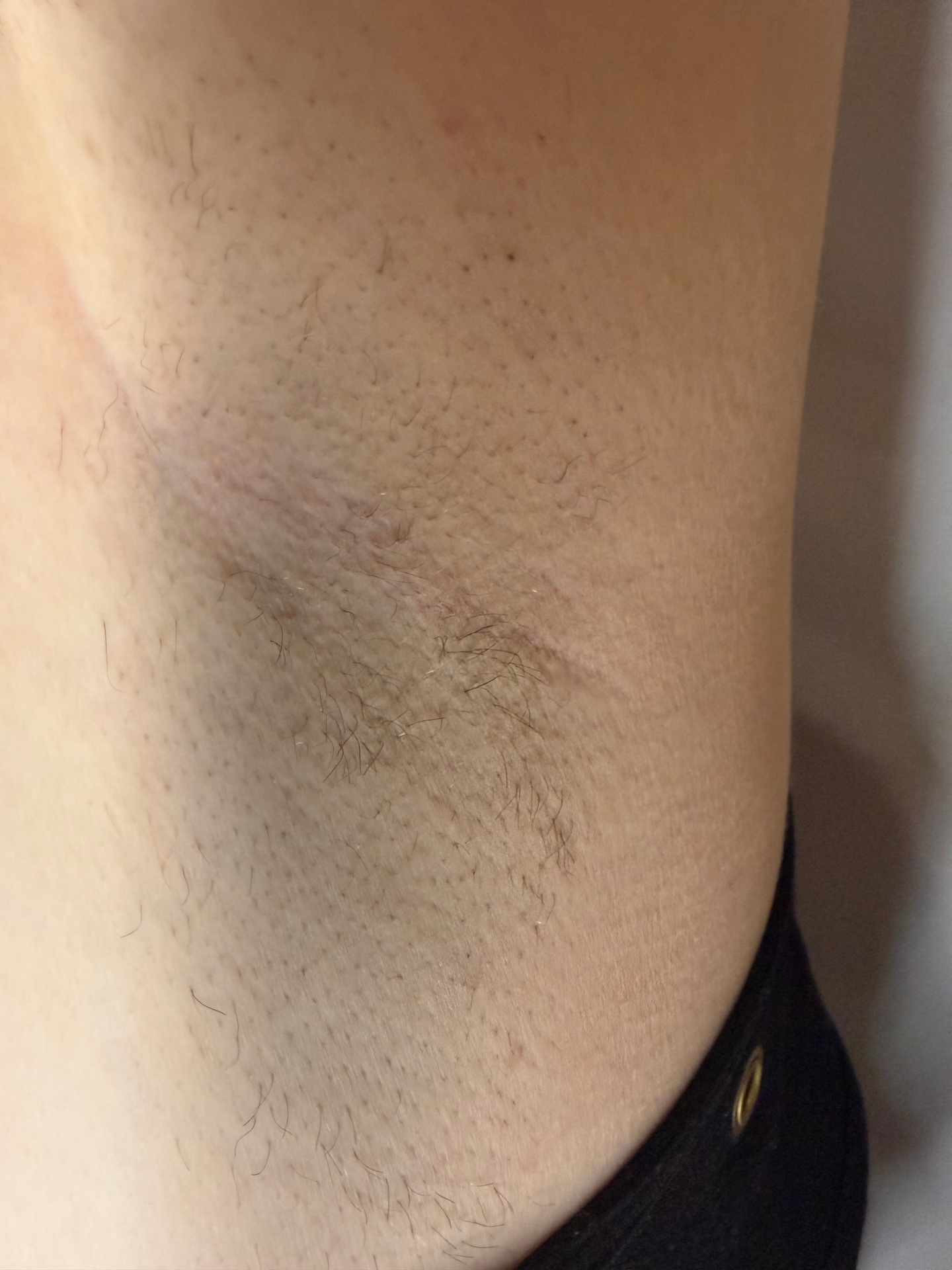 Underarm hair reduction after 2 laser sessions